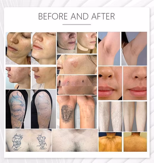 2023 M22 IPL Opt peau photon rajeunissement beauté équipement Aopt Laser M22 Lumenis Resurfx Cool épilation Machine